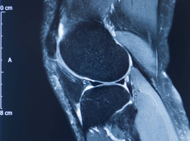Diz yaralanması MRI MCL gözyaşı