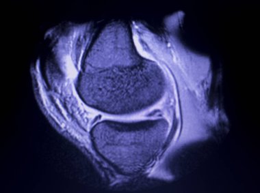Mr diz menisküs gözyaşı tarama