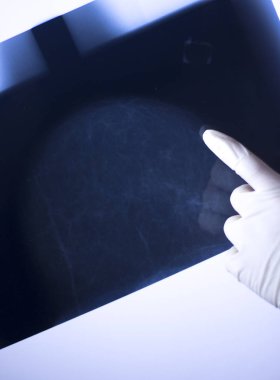 Xray meme tcan mamografi