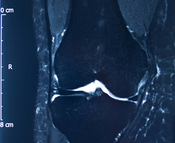 Térdsérülés MRI MCL könny — Stock Fotó