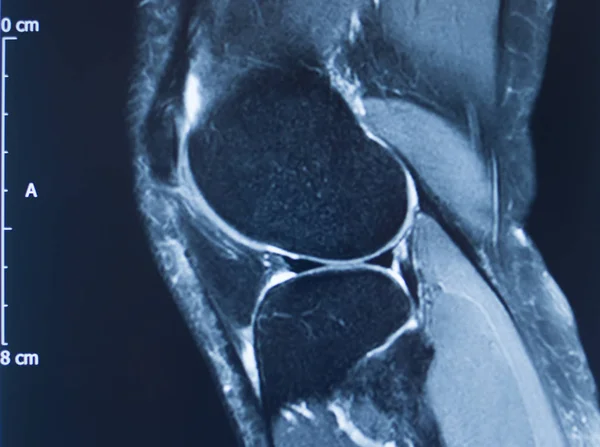 Травма коліна mri mcl сльоза — стокове фото