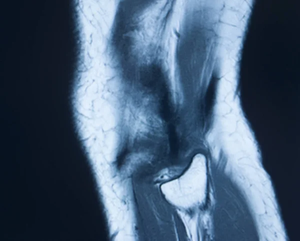 Knee injury mri mcl tear