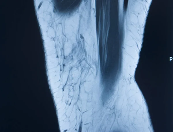 Knee injury mri mcl tear — Stock Photo, Image