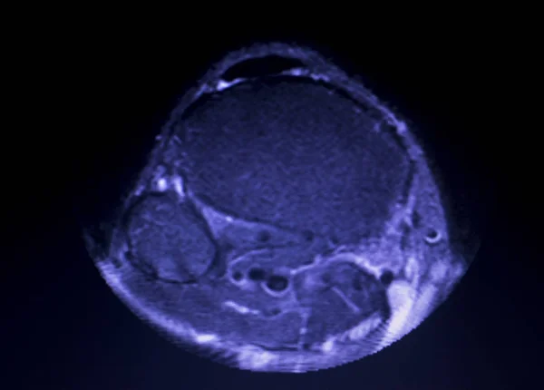 MRI térd meniszkusz könny vizsgálat — Stock Fotó