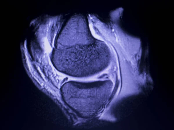 МРТ сканування меню розриву коліна — стокове фото