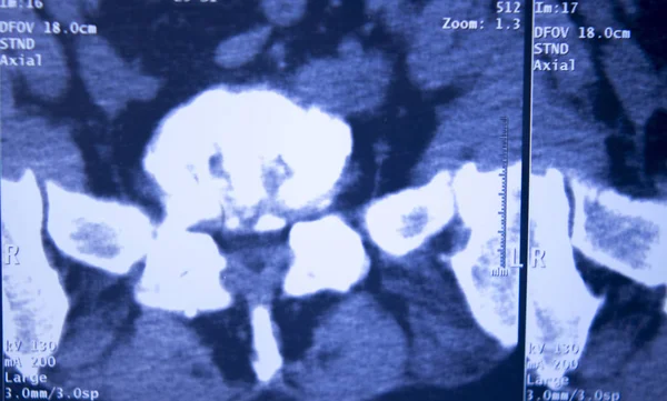 의료용 힙 척추 골반 Mri 스캔 — 스톡 사진