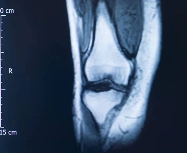 Knee injury mri mcl tear — Stock Photo, Image