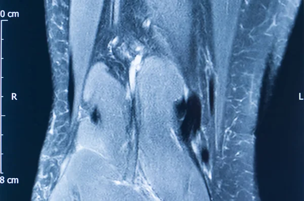 Lesão no joelho mri mcl rasgo — Fotografia de Stock