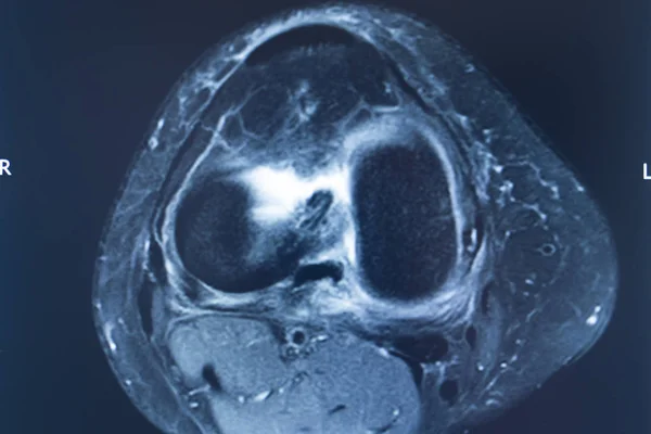 Травма колена mri mcl разрыв — стоковое фото