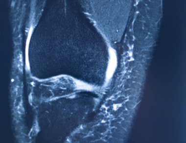 Diz yaralanması MRI MCL gözyaşı