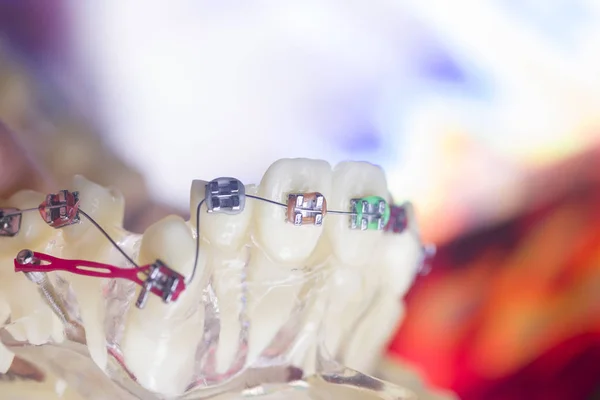 Fogászati konzolok fogak kiegyenesítők — Stock Fotó