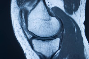 Diz yaralanması MRI MCL gözyaşı
