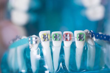 Diş braketleri diş düzleştiriciler