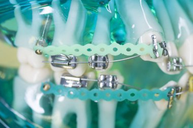 Diş braketleri diş düzleştiriciler