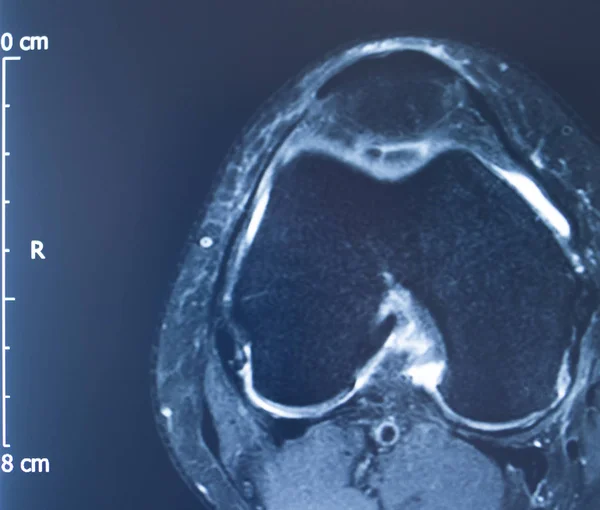 Urazy kolana MRI MCL Tear — Zdjęcie stockowe