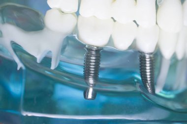 Diş hekimi diş implantı diş modeli