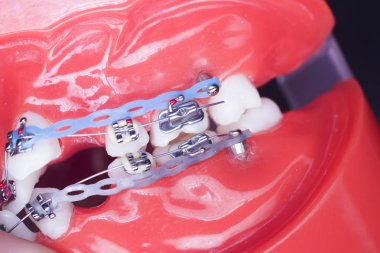 Diş braketleri diş düzleştiriciler