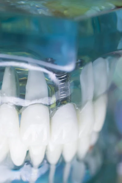 Denti dentisti impianto modello dentale — Foto Stock