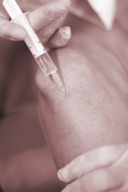 Epi lingling fizik tedavi