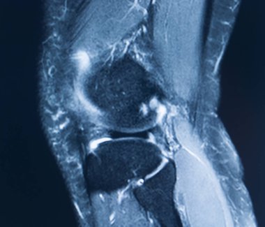 Diz yaralanması MRI MCL gözyaşı