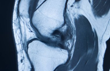 Diz yaralanması MRI MCL gözyaşı