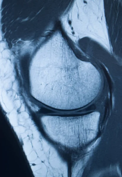 Knee injury mri mcl tear