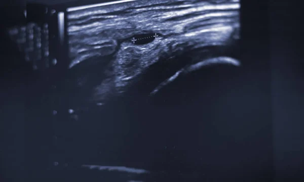 EPI dry needling ultrasound scan — Stock Photo, Image