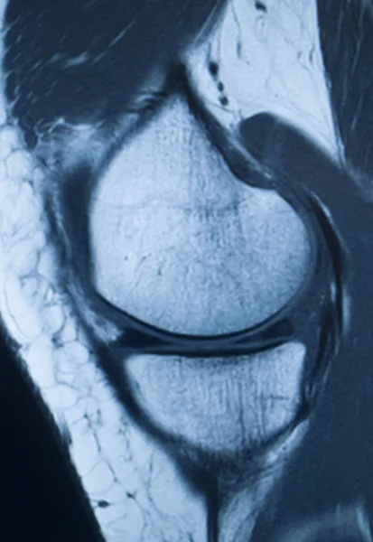 Lesioni al ginocchio mri mcl strappo — Foto Stock