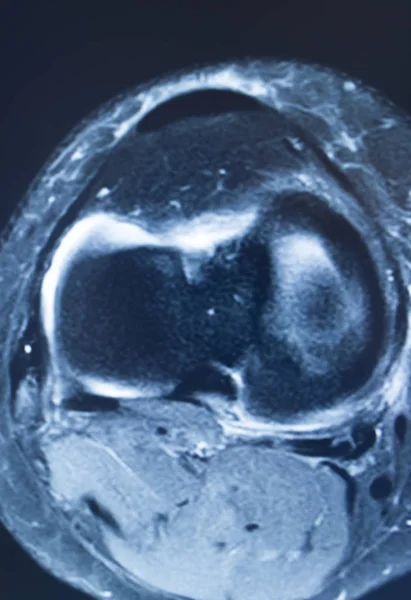 Knie letsel MRI mcl scheur — Stockfoto