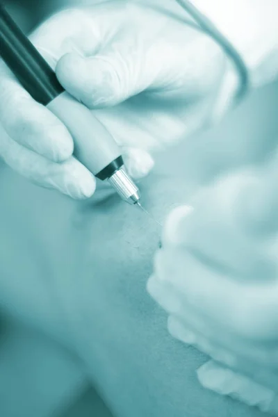 Epi Needling fysiotherapie — Stockfoto