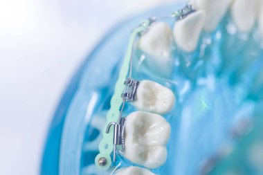 Diş braketleri diş düzleştiriciler