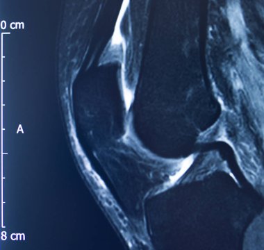 Diz yaralanması MRI MCL gözyaşı