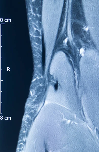 Térdsérülés MRI MCL könny — Stock Fotó