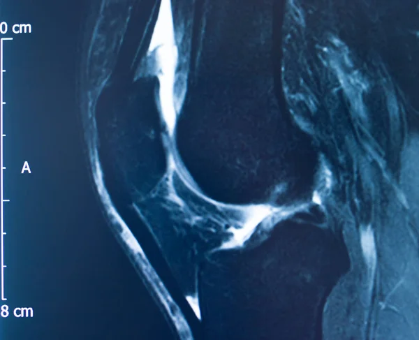 Knee Sports Injury Mri Mcl Grade Tear Magnetic Resonance Imaging — Stock Photo, Image