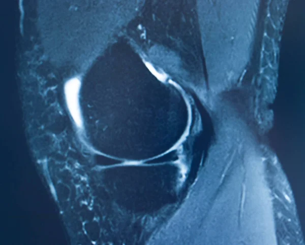 Knieverletzung Mri Mcl Grade Reißen Magnetresonanztomographie Orthopädische Traumatologie Scan — Stockfoto