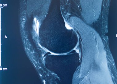 Diz sporu yaralanması MRI derecesi 2 yırtık manyetik rezonans görüntüleme ortopedik travmatoloji taraması.