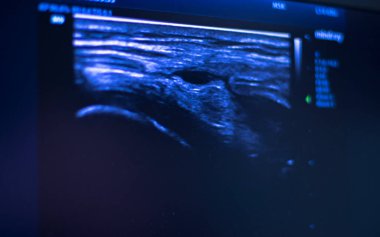 EPI Doku İçi Perkütan Elektroliz kuru iğneli ultrason ekografi fizyoterapi tedavisi.