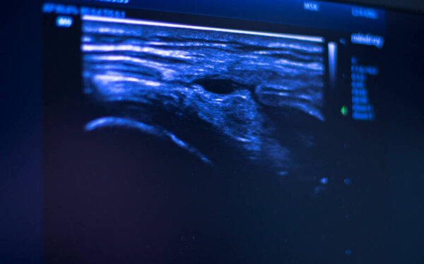 EPI Intratissue Перкутанный электролиз сухого иглоукалывания экография сканирования физиотерапии медицинское лечение.