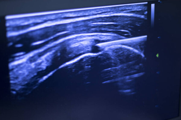 EPI Intratissue Перкутанный электролиз сухого иглоукалывания экография сканирования физиотерапии медицинское лечение.