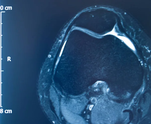 Knieverletzung Mri Mcl Grade Reißen Magnetresonanztomographie Orthopädische Traumatologie Scan — Stockfoto