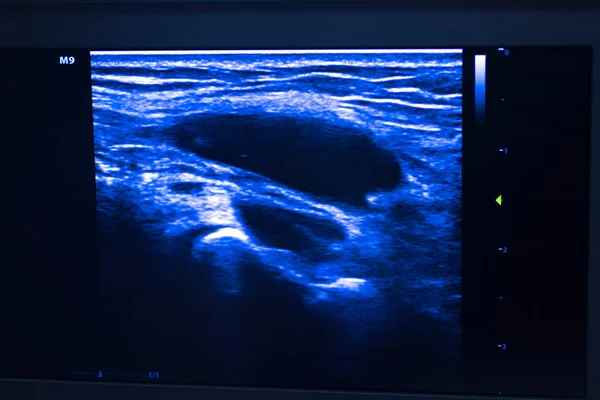 Epi Intratissue Electrolisis Percutánea Punción Seca Ecografía Ecografía Exploración Fisioterapia — Foto de Stock