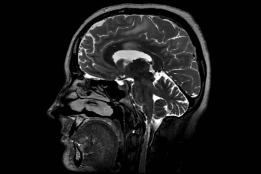 İnsan beyninin hesaplanan rezonans görüntüleme.