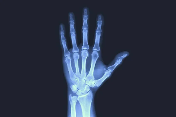 对人类的手进行 x 光检查手骨 x 光片. — 图库照片
