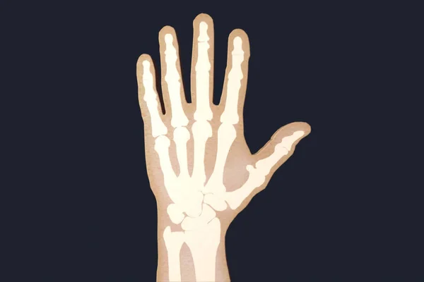 Prześwietlenie ludzką ręką. RTG kości ręki. — Zdjęcie stockowe