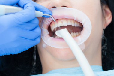 Bir kadın diş hijyenik ve diş kliniği profesyonel diş beyazlatma ve Ultrasonik Temizleme. Odontics ve ağız sağlığı.