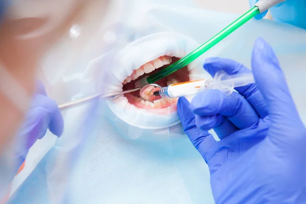 Närbild tandläkare med en assistent behandlar childs tänderna, patienter ansiktet är stängd — Stockfoto