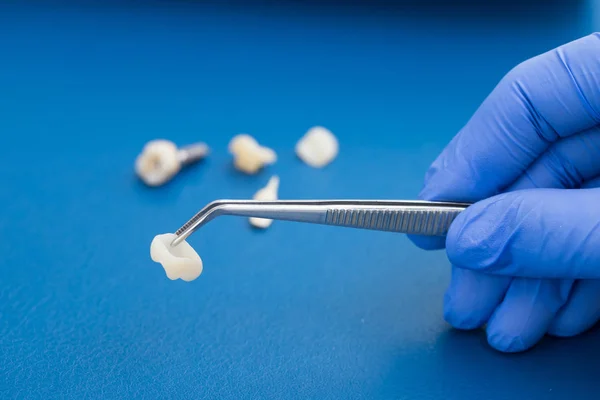 Um dentista está segurando pinças para folheados de cerâmica dental e coroas . — Fotografia de Stock