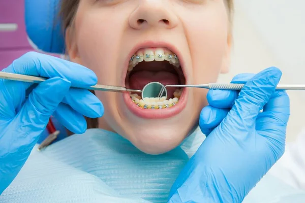 Chica con aparatos ortopédicos en la recepción en el dentista. Primer plano. Guante de mano con una herramienta en los dientes del paciente . — Foto de Stock