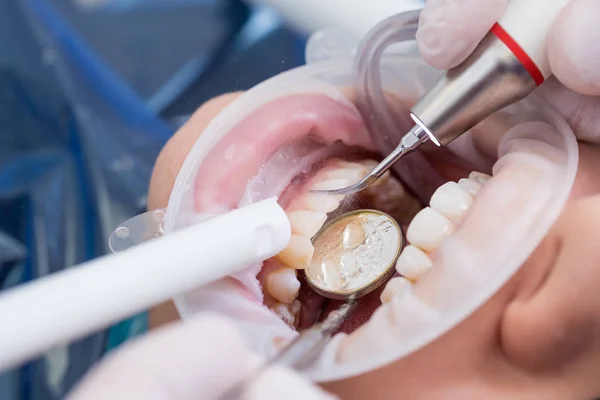 Närbild av modern professionell tandrengöring inom tandvården med specialutrustning. Patienten bär ett upprullningsdon — Stockfoto