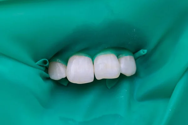 Placa de látex de primer plano diseñada para aislar el diente a tratar del resto de la cavidad oral durante el tratamiento. El dentista preparó los dientes delanteros para el tratamiento . — Foto de Stock